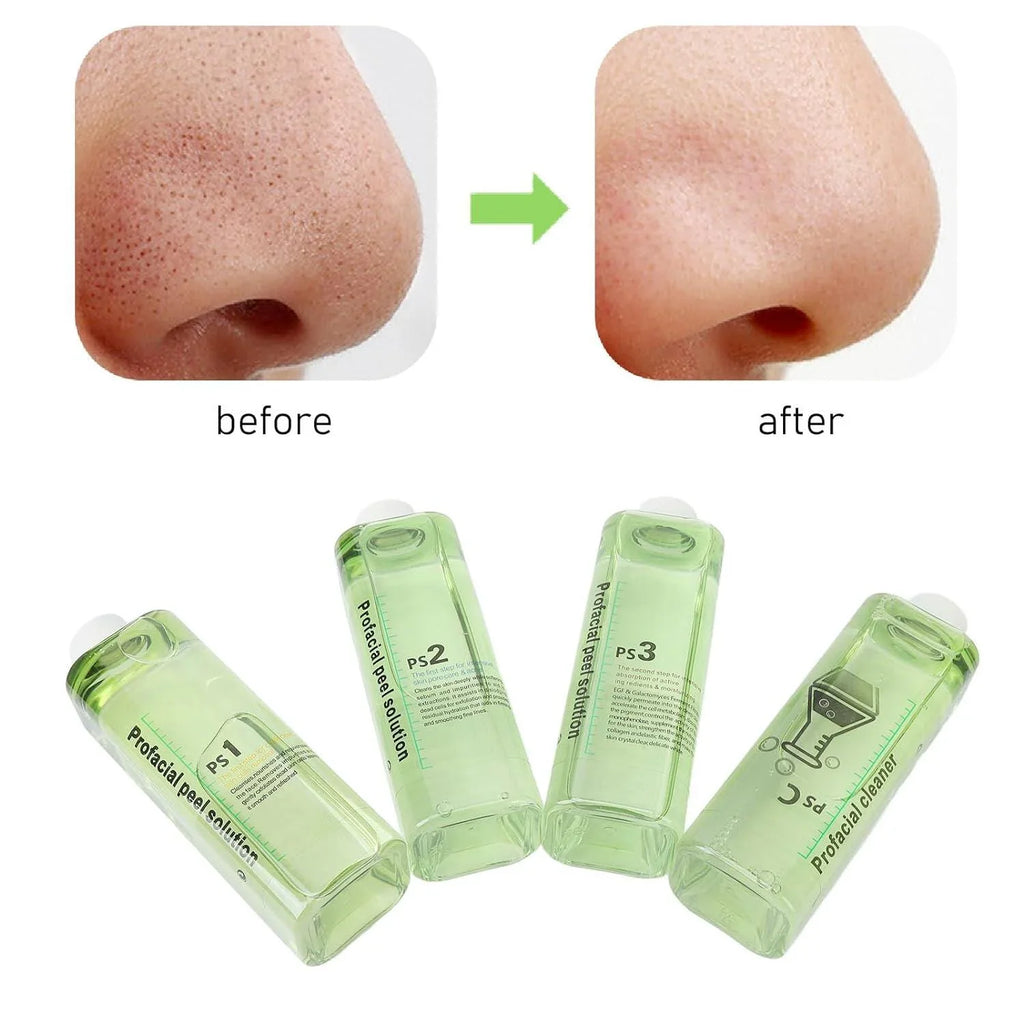 4pcs Hydra Peeling Facial Serum for Dermabrasion Machine Deep Cleansing Hydro Dermabrasion Solution Daily Skin Care Brightening and Hydrating Facial Serum