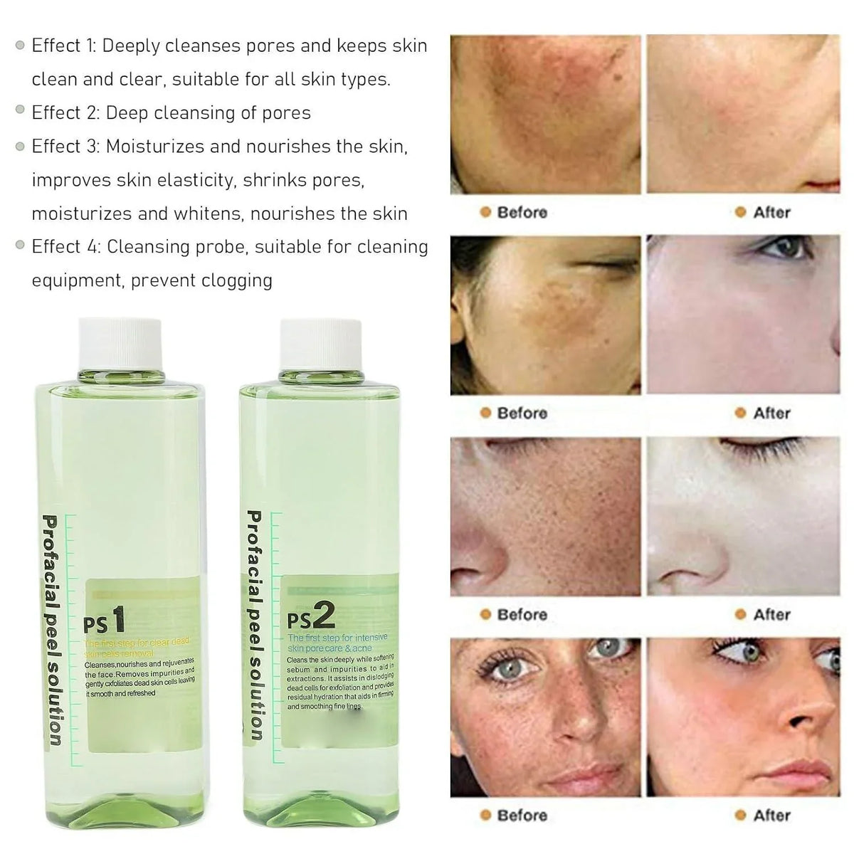 4pcs Hydra Peeling Facial Serum for Dermabrasion Machine Deep Cleansing Hydro Dermabrasion Solution Daily Skin Care Brightening and Hydrating Facial Serum
